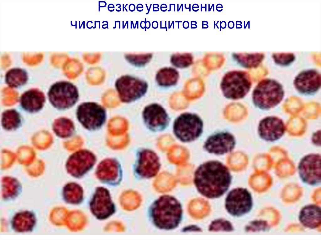 Лейкоз крс. Лейкоз КРС возбудитель. Вирус лейкоза КРС возбудитель. Лейкоз крупного рогатого скота картина крови.