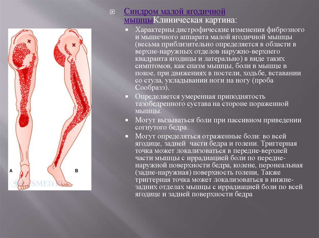 Иррадиация боли в ногу. Синдром малой ягодичной мышцы. Мышечный спазм ягодичной мышцы. Миофасциальный болевой синдром. Миофасциальный синдром ягодичных мышц.
