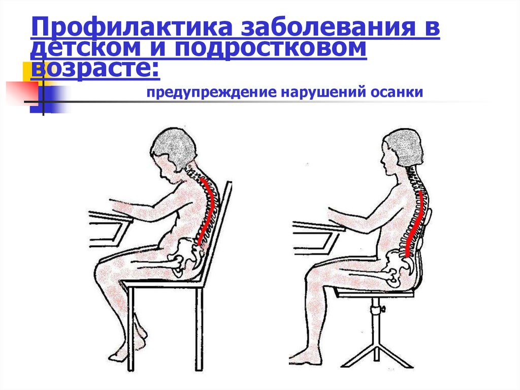 Виды нарушения осанки профилактика нарушений