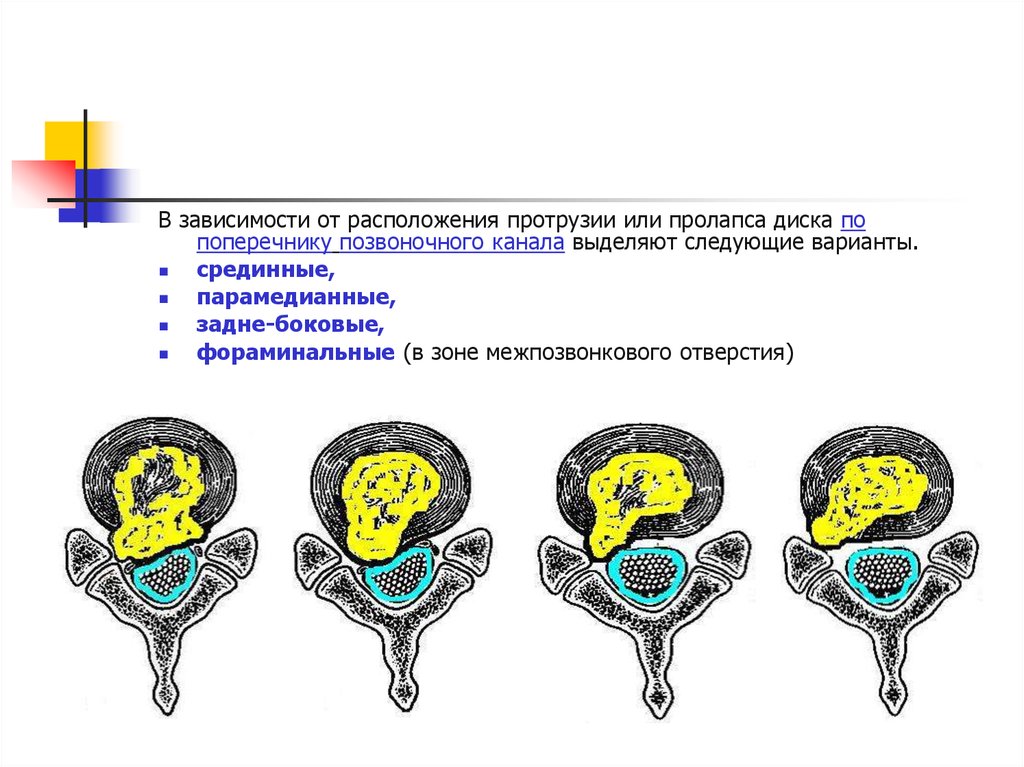 Дорзальная парамедиальная грыжа диска. Левосторонняя парамедианная протрузия. Левосторонняя парамедианная протрузия межпозвоночного диска. Классификация грыж межпозвонковых дисков кт. Классификация грыж позвоночника на кт.