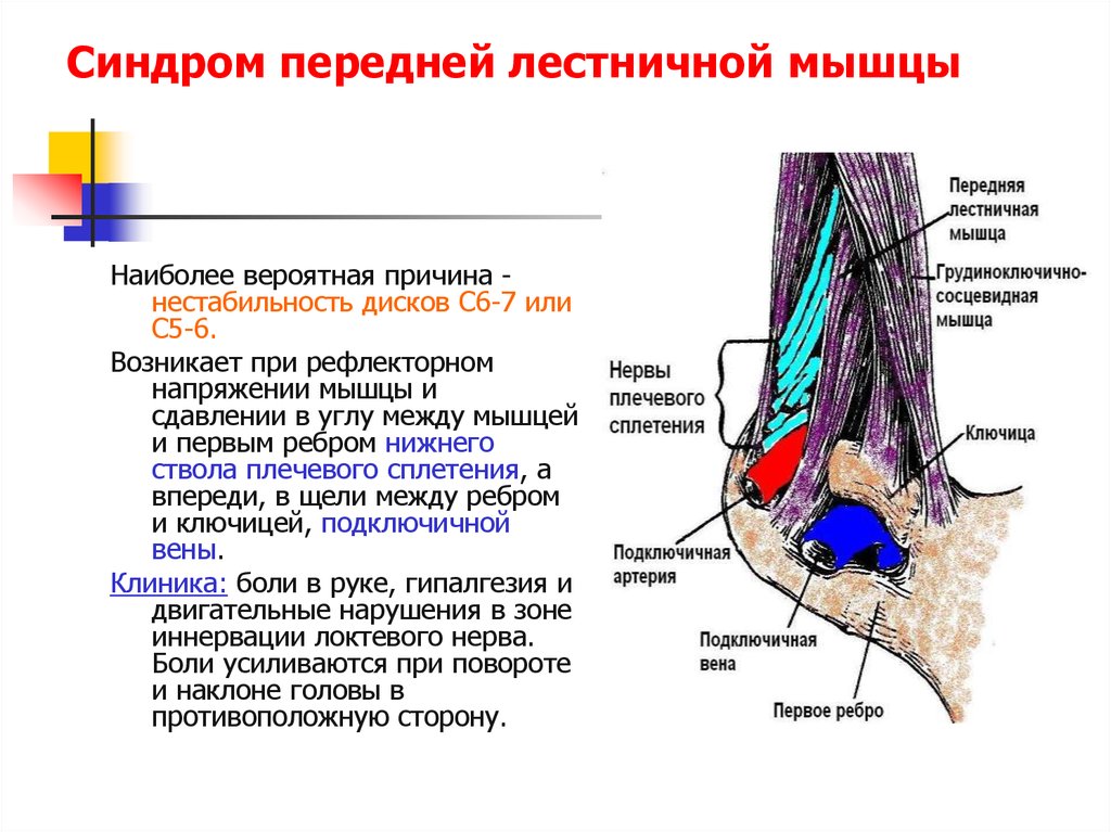 Симптом лестничной мышцы. Синдром передней лестничной мышцы. Синдром лестничной мышцы. При синдроме передней лестничной мышцы. Синдром передней и средней лестничных мышц.