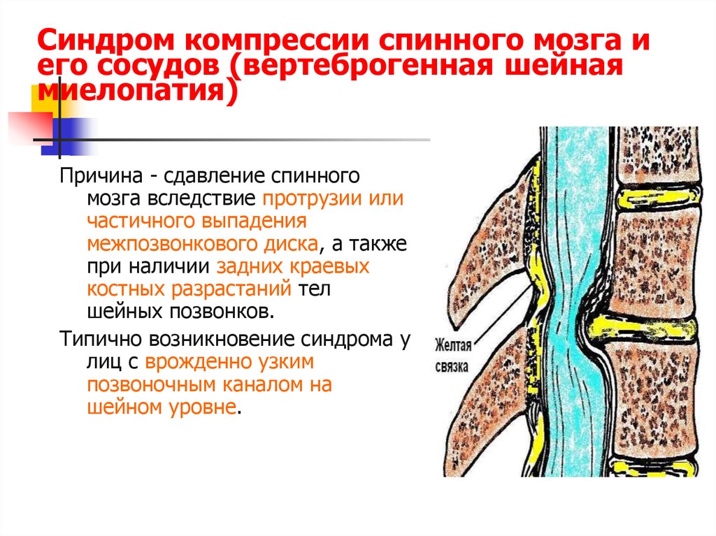 Почему после спинальной. Компрессия спинного мозга симптомы. Синдром компрессии спинного мозга. Признаки компрессии спинного мозга. Миелопатии спинного мозга.