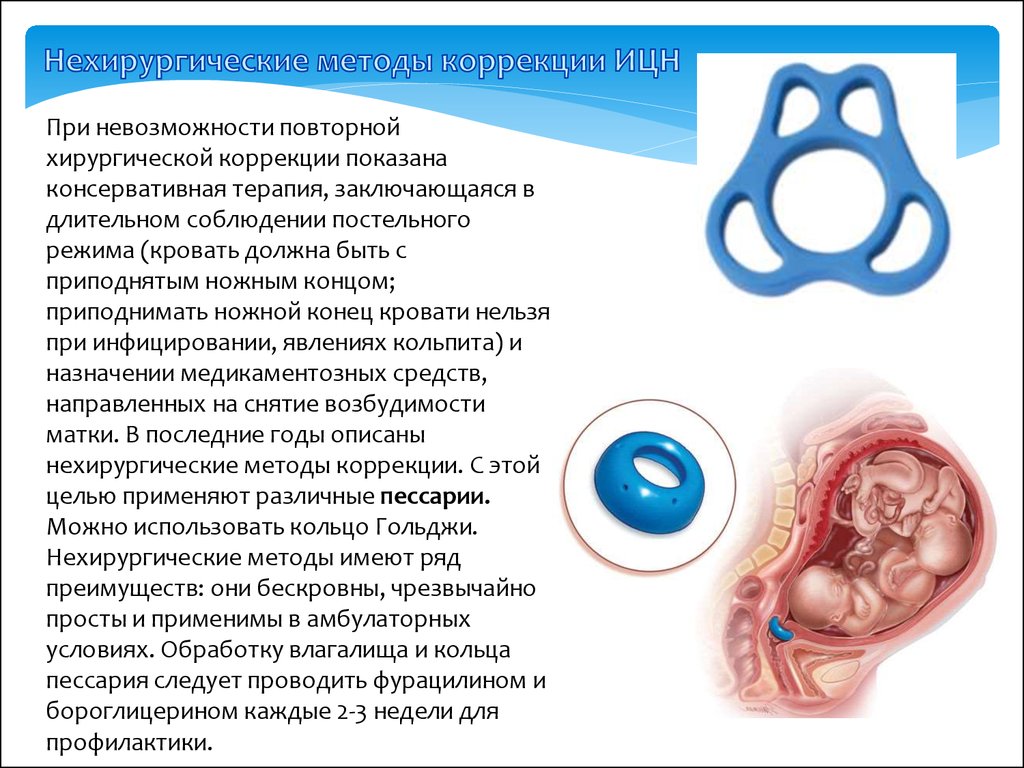 Кольцо для беременности
