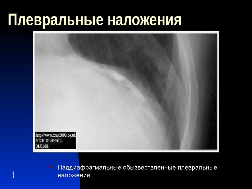 Кардиодиафрагмальный синус