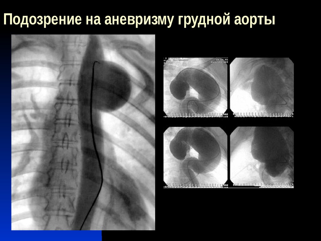 Аневризма грудной аорты фото