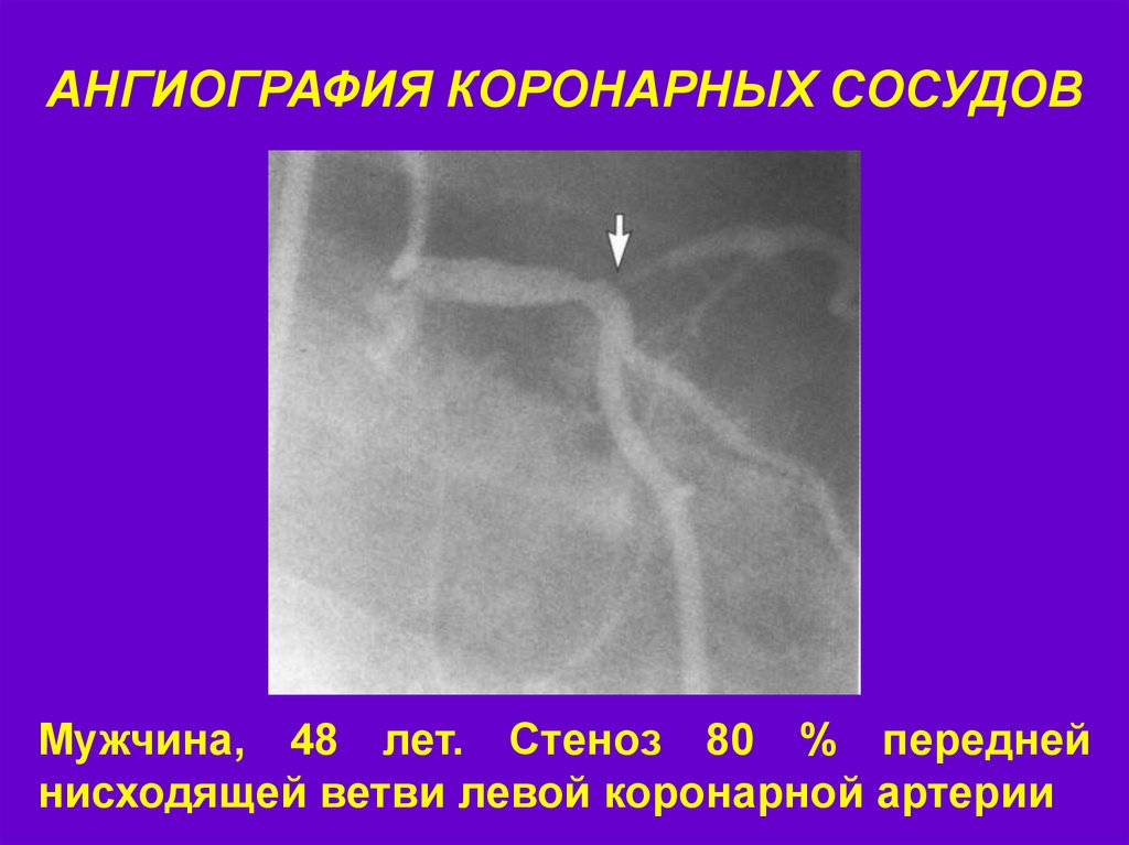 Стеноз артерий сердца. Ангиография коронарных сосудов. Стеноз передней нисходящей артерии. Стеноз коронарных артерий. Стеноз левой коронарной артерии.