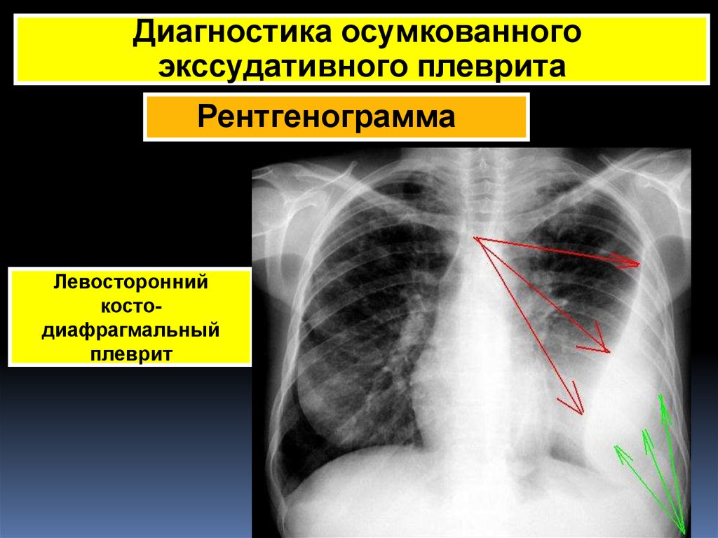 Диагноз экссудативный плеврит