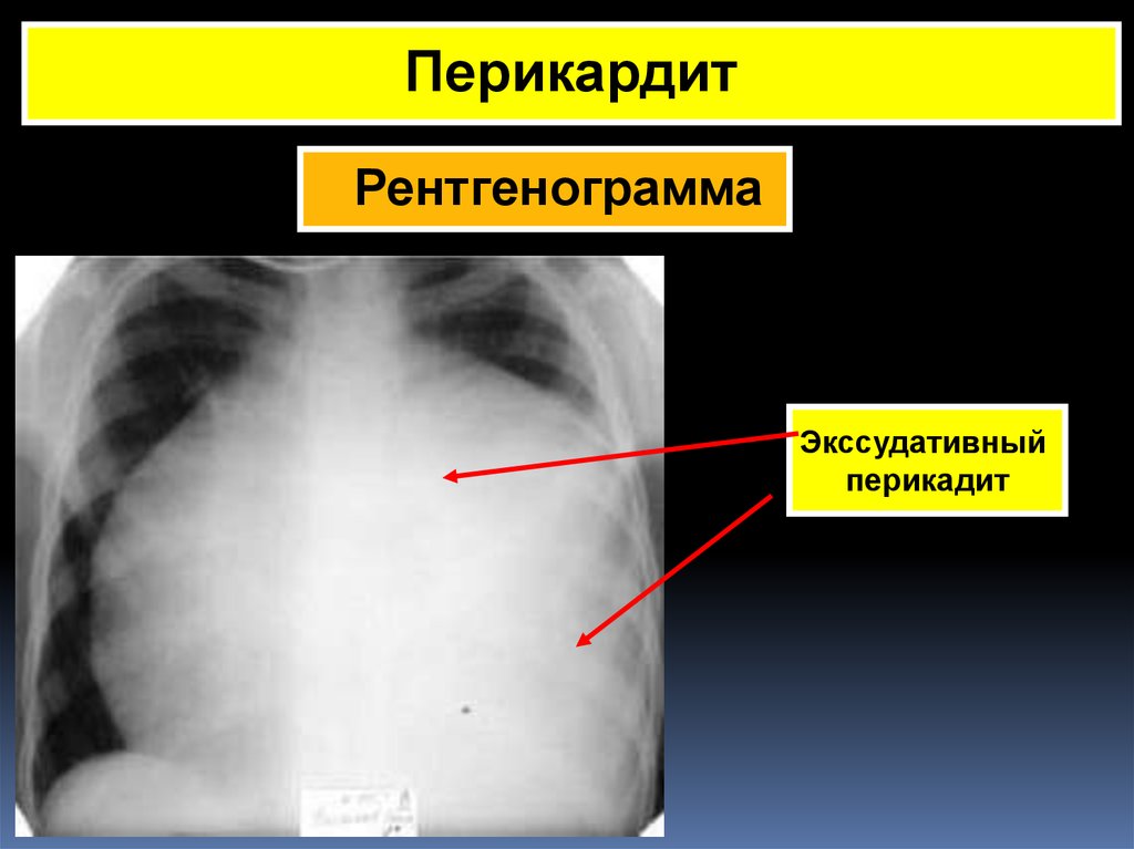 Выпотной перикардит. Выпотной перикардит рентген. Экссудативный перикардит рентген. Рентгенография перикардит. Констриктивный перикардит рентген.