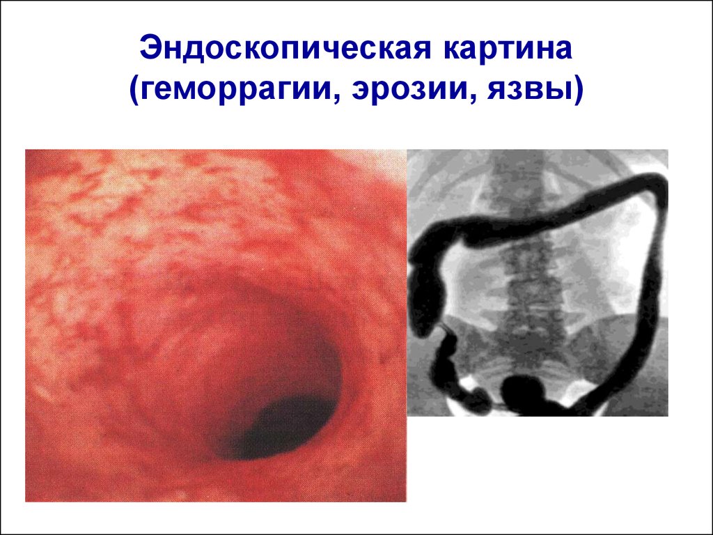 Эндоскопическая картина гпод