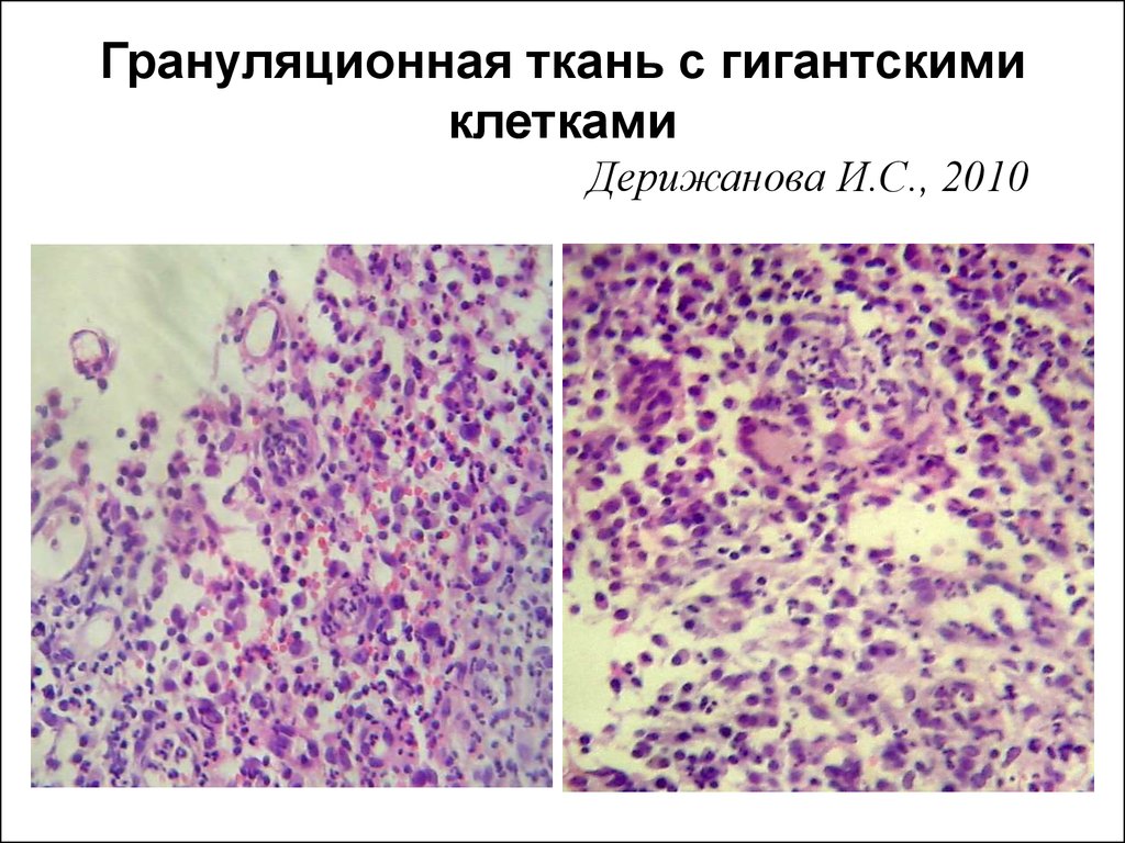 Грануляционная ткань. Грануляционная ткань микро. Грануляционная ткань макропрепарат. Грануляционная ткань микропрепарат. Грануляционная ткань микропрепарат патанатомия.