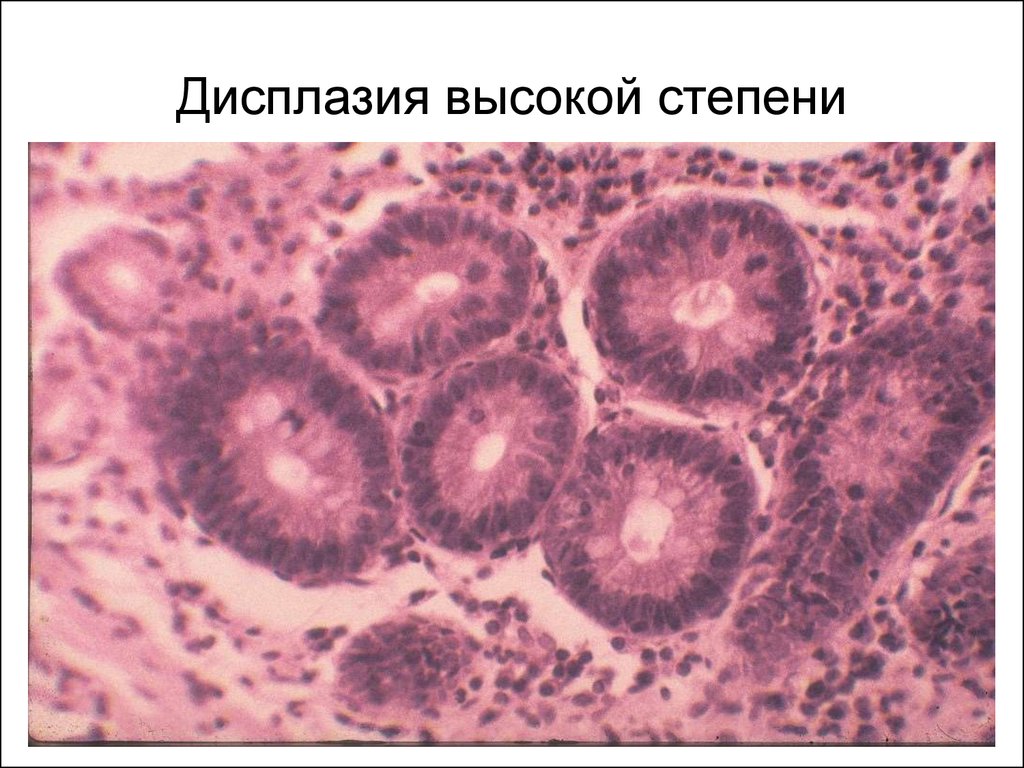 Степени дисплазии. Дисплазия эпителия гистология. Дисплазия эпителия кишечника 2-3. Дисплазия эпителия толстой кишки 1 степени. Дисплазия толстой кишки гистология.