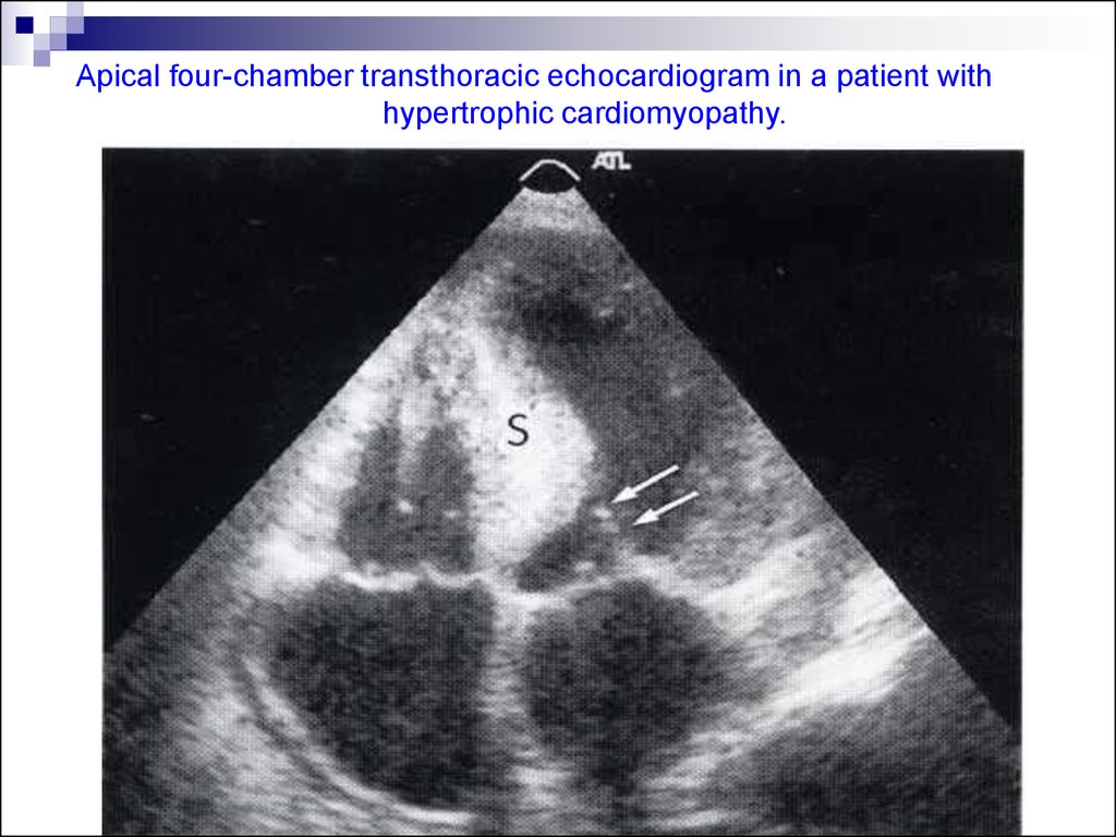 Apical four-chamber transthoracic echocardiogram in a patient with hypertrophic cardiomyopathy.