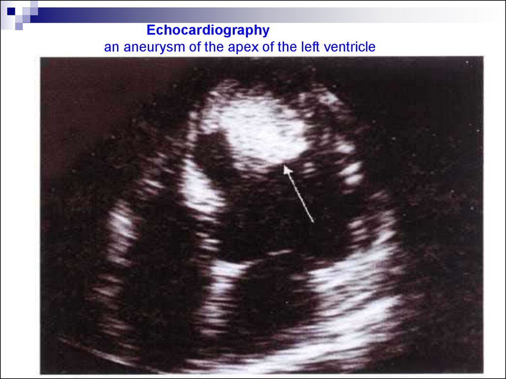 Echocardiography an aneurysm of the apex of the left ventricle
