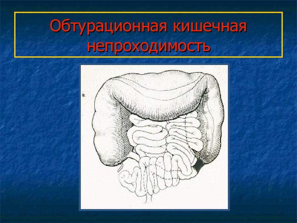 Кишечная непроходимость. Мезентериальная непроходимость. Обтурационная кишечная непроходимость. Обтурационная толстокишечная непроходимость. Кишечная непроходимость презентация.