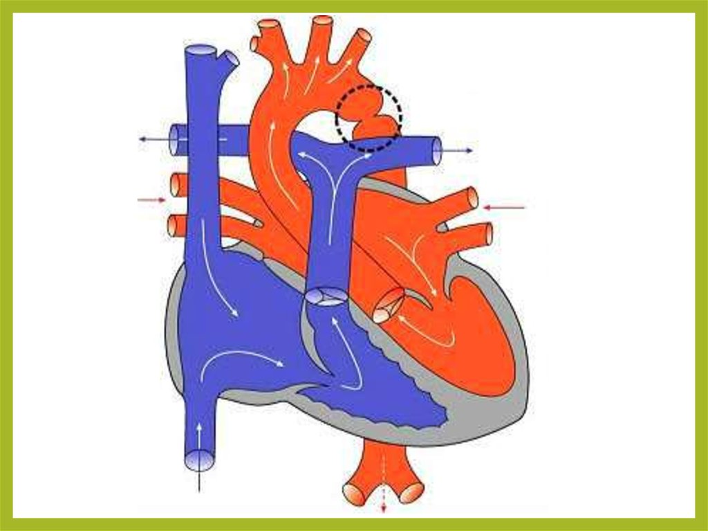 Открытый артериальный проток у детей презентация