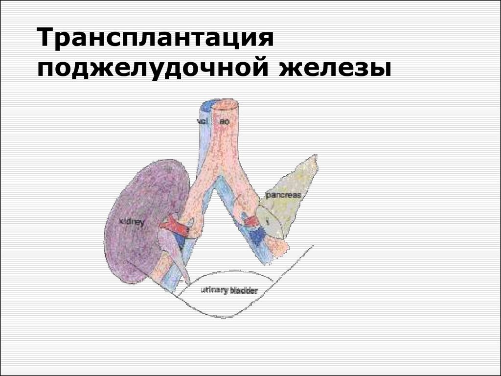 Пересадка поджелудочной железы при сахарном диабете. Трансплантация поджелудочной железы. Трансплантология поджелудочной железы. Трансплантация клеток поджелудочной железы. Трансплантация островковых клеток.