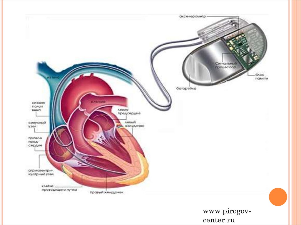 Почему в инструкции людям с кардиостимуляторами запрещается. Установка искусственного водителя ритма сердца.. Кардиостимулятор устройство и принцип работы. Строение кардиостимулятора. Кардиостимулятор сердца установленный.