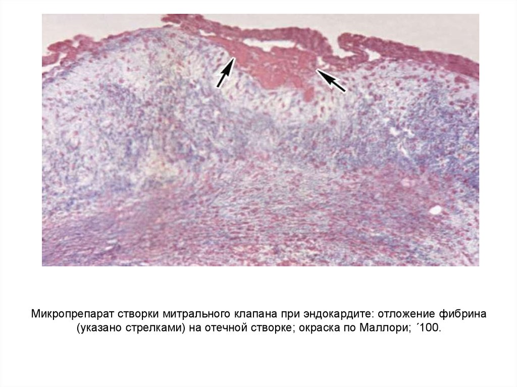 Митральный клапан гистология рисунок