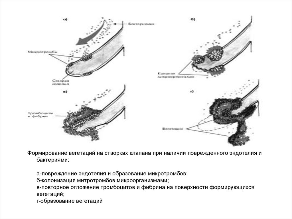 Формирование вегетаций на створках клапана при наличии поврежденного эндотелия и бактериями: а-повреждение эндотелия и образование микро