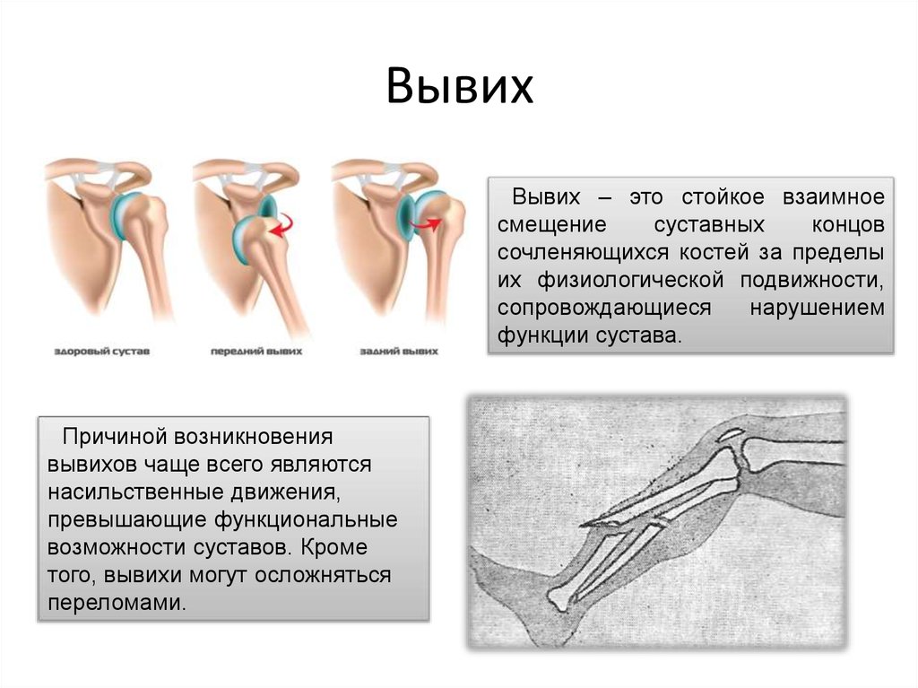 Вывих и подвывих схема