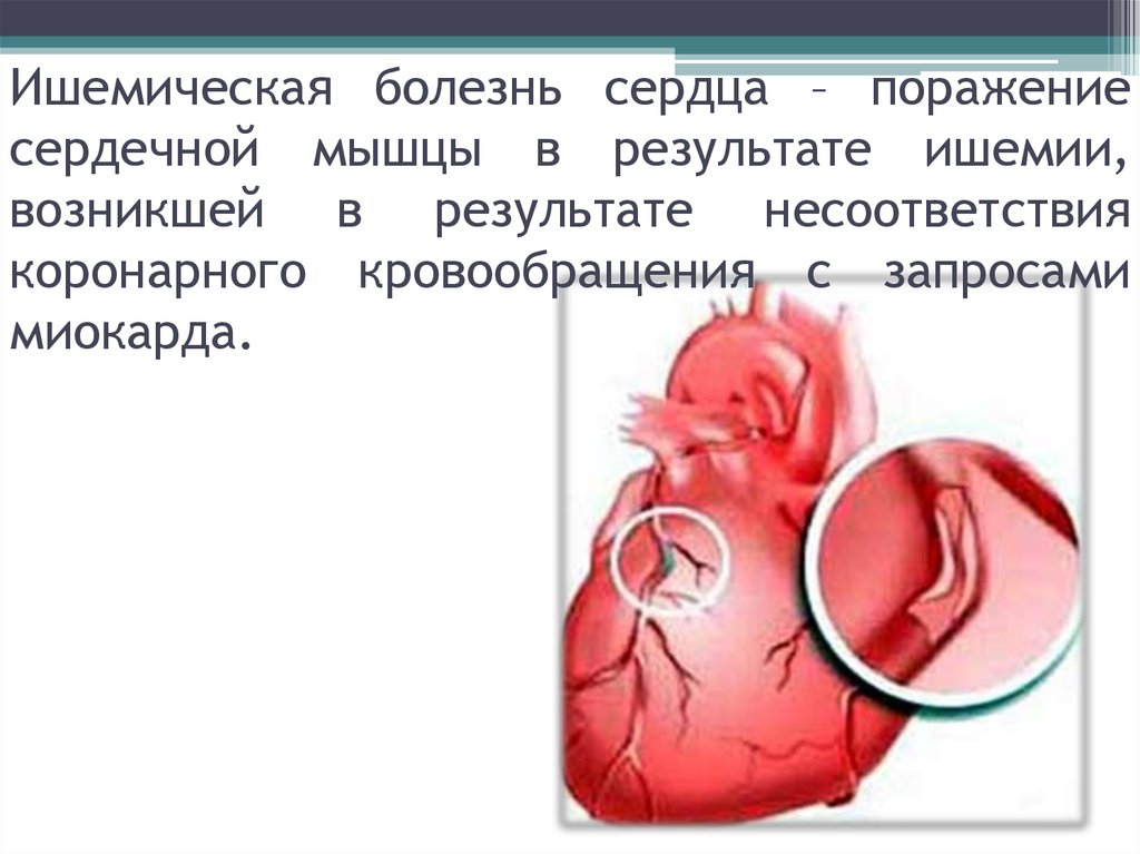 В самое сердце на поражение. Болезнь сердечной мышцы. Поражение сердечной мышцы. Ишемия сердечной мышцы. Ишемическое заболевание сердечной мышцы.