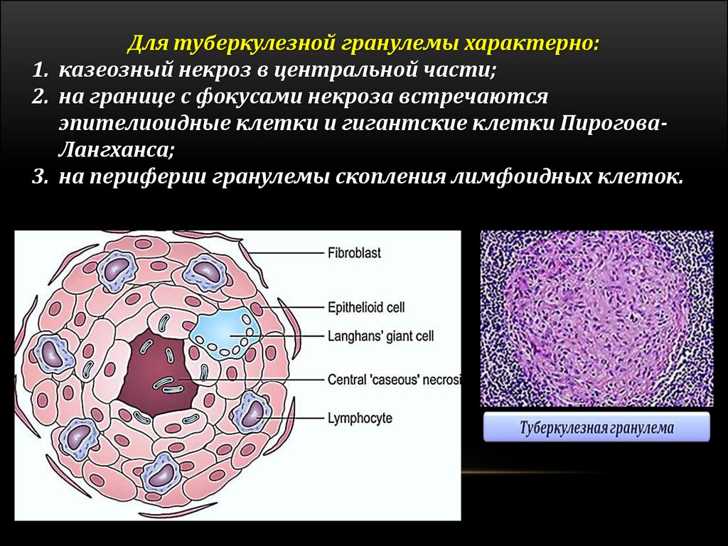 Туберкулезный латынь. Клетки Пирогова Лангханса. Многоядерные клетки Пирогова-Лангханса. Туберкулезная гранулема. Туберкулезная гранулема строение.