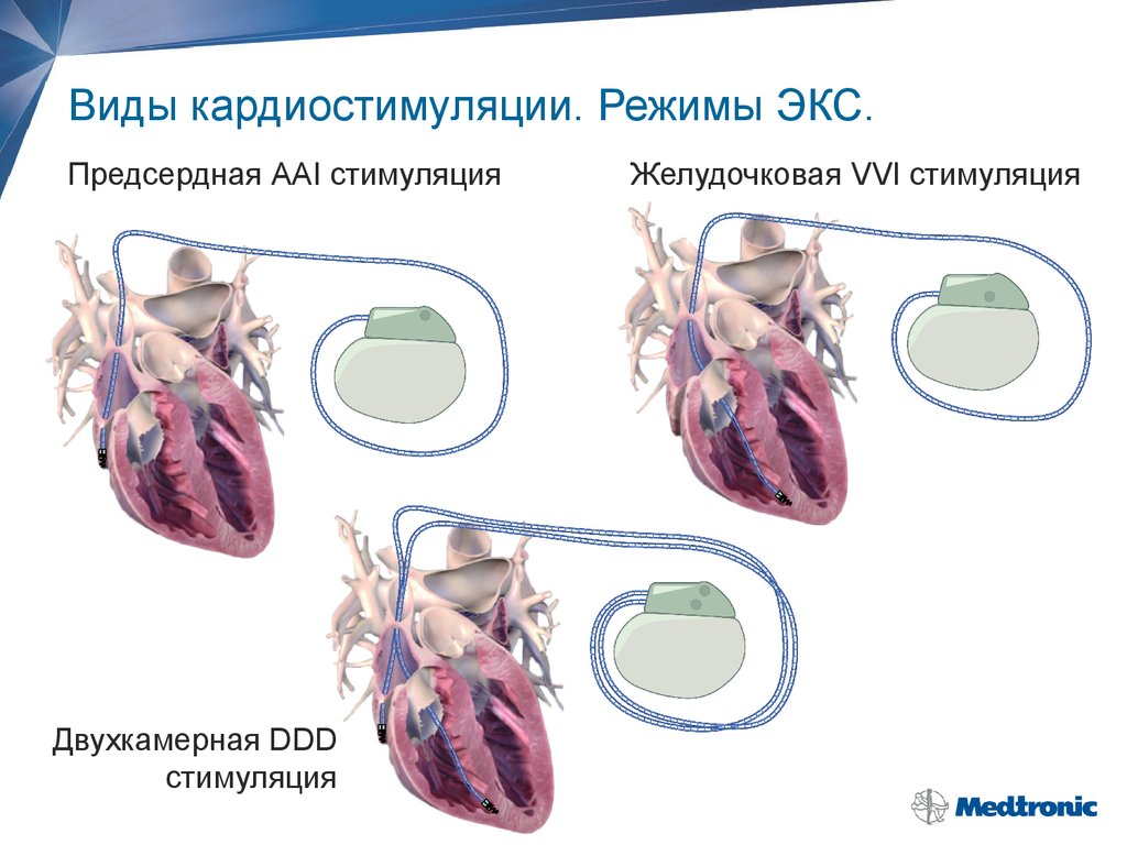 Экс ч. Виды электрокардиостимуляторов. Режимы работы кардиостимулятора. Разновидности кардиостимуляторов. Однокамерный кардиостимулятор.