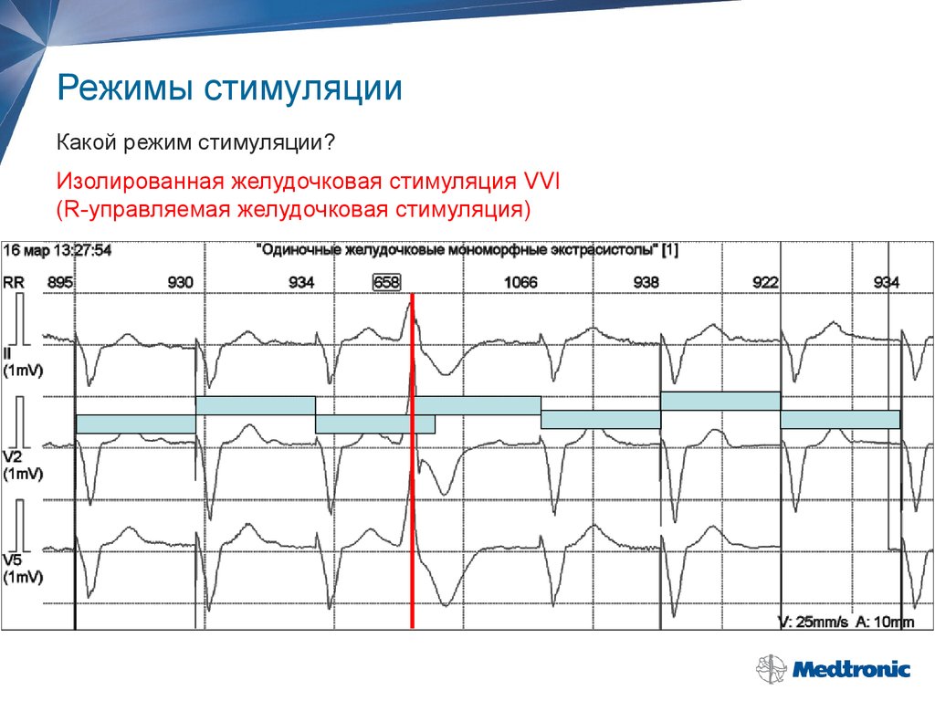 Режимы работы экс. Режимы стимуляции. Режимы работы кардиостимулятора. Режим стимуляции VVI.