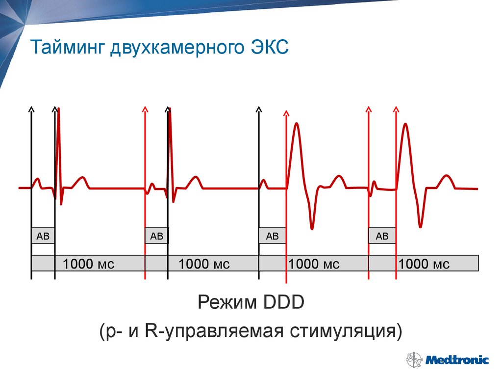 Мс мс режим. Режим DDD кардиостимулятора. Режимы кардиостимуляции на ЭКГ. Электрокардиостимуляции в режиме DDDR. Режим стимуляции DDD.