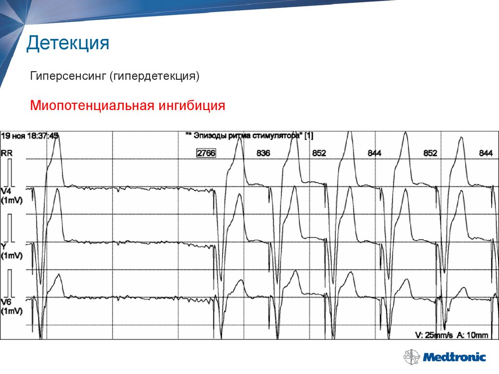 Детекция. Детекция экс это. Гиперсенсинг. Миопотенциальная ингибиция. Нарушение функции детекции экс.