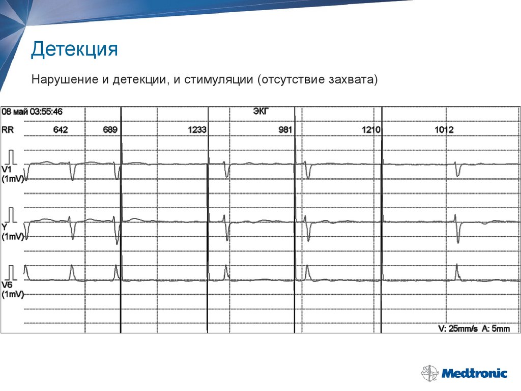 Детекция. Нарушение функции детекции. Нарушение функции детекции экс. Детекция экс это. Нарушение функции детекции кардиостимулятора.