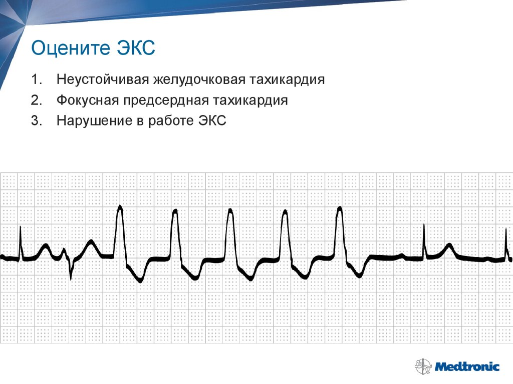 Путем экс. Неустойчивая желудочковая тахикардия. Фокусная предсердная тахикардия. Фокусная тахикардия это. Тахикардия при экс.