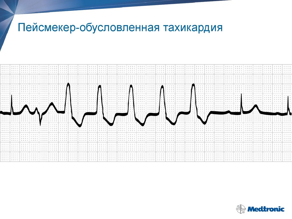 Пейсмекер