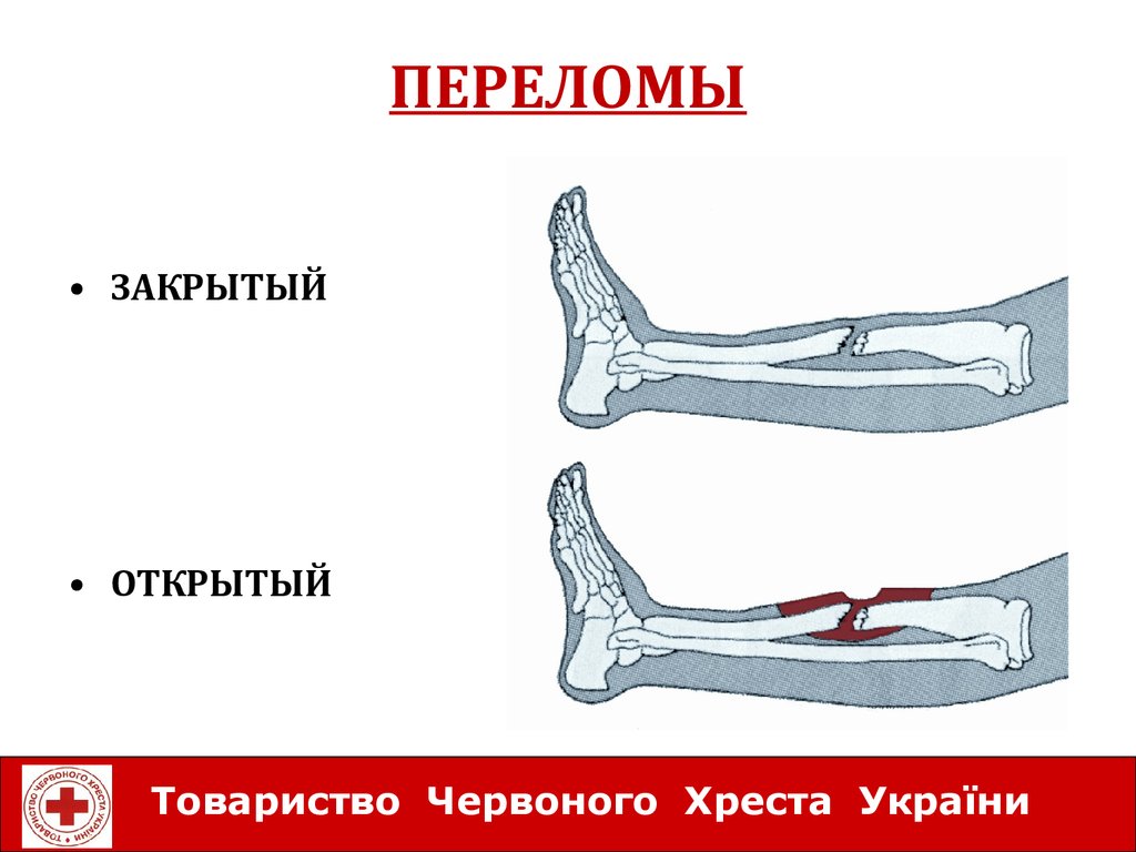 Открытый перелом костей конечности