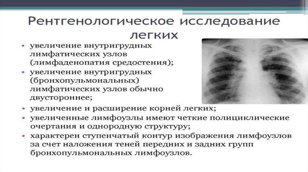 Саркоидоз мкб 10 у взрослых. Саркоидоз легкого рентген. Стадии саркоидоза легких на рентгене. Рентген признаки саркоидоза легких. Рентген стадии саркоидоза.