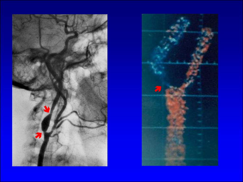 Гипоплазия позвоночной. Аневризма позвоночной артерии. Тромбоэмболия позвоночной артерии.