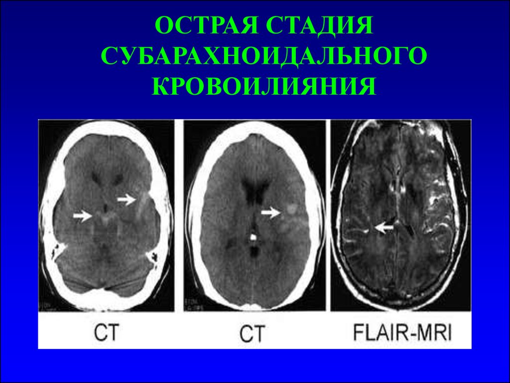 Конвекситальные пространства. Субарахноидальные пространства на кт. Острая стадия кровоизлияния мрт. Острая стадия. Субарахноидальный инсульт степень.