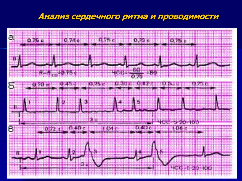 Ритм проводимости. Правильный неправильный ритм ЭКГ. Анализ сердечного ритма. Анализ сердечного ритма и проводимости. Оценка регулярности сердечного ритма.