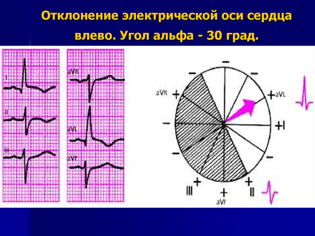 Экг ось отклонена влево. Смещение электрической оси сердца влево на ЭКГ. Отклонение электрической оси влево на ЭКГ. Электрическая ось сердца отклонена влево на ЭКГ. Отклонение электрической оси сердца на ЭКГ.
