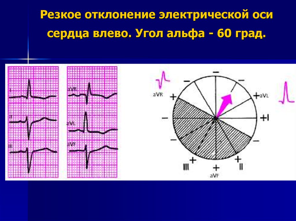 Экг ось отклонена влево. Электрическая ось сердца отклонена влево на ЭКГ. Отклонение ЭОС влево на ЭКГ. Отклонение электрической оси сердца влево угол Альфа. Отклонение электрической оси влево на ЭКГ.