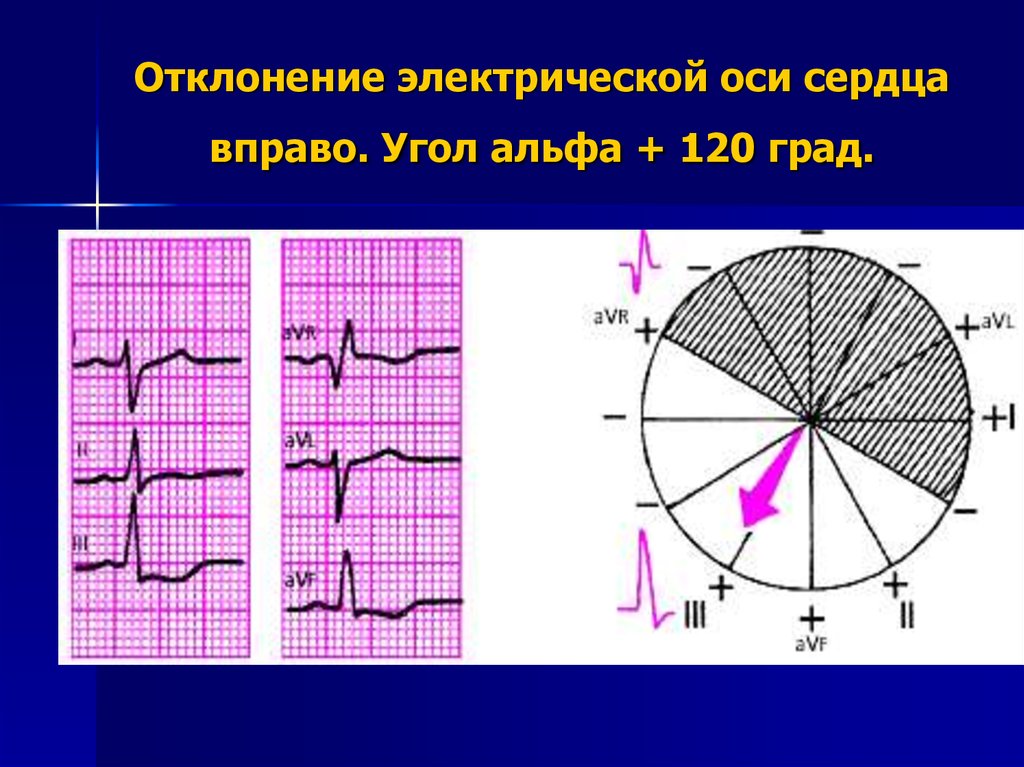 Сердце отклонено вправо. Электрическая ось вправо на ЭКГ. Отклонение оси вправо на ЭКГ. Отклонение ЭОС вправо на ЭКГ. Отклонение электрической оси сердца вправо.