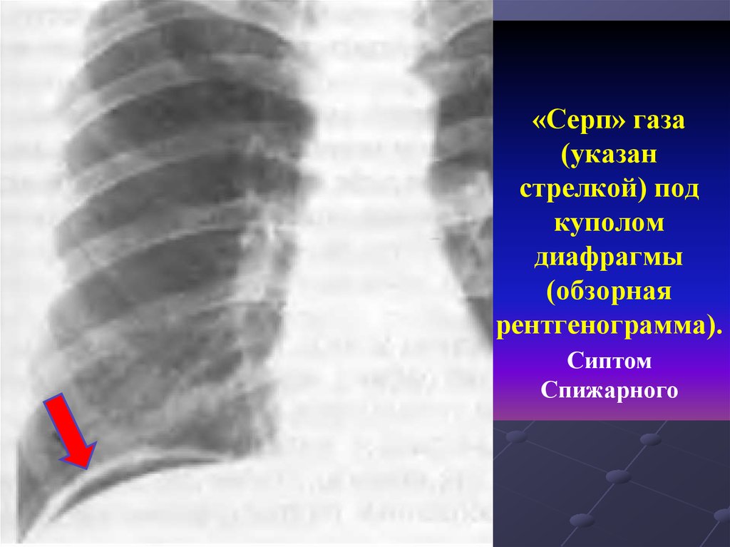 Свободный газ. Свободный ГАЗ под левым куполом диафрагмы рентген. ГАЗ под куполом диафрагмы рентген. ГАЗ под диафрагмой рентген. Свободный ГАЗ под куполом диафрагмы рентген.