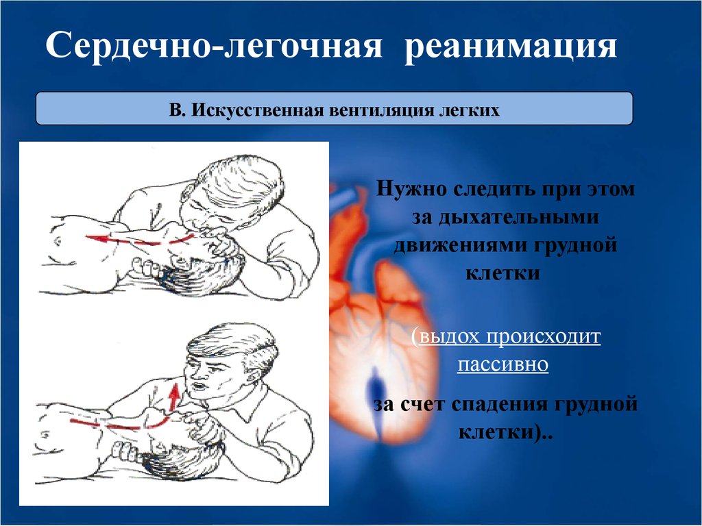 Легочно сердечная реанимация обучение