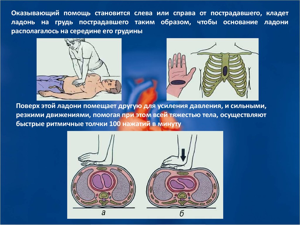 Ошибки при выполнении реанимационных мероприятий. Надавливание на глазные яблоки при тахикардии. Массаж сонной артерии при тахикардии. Реанимационные мероприятия при разрыве матки.