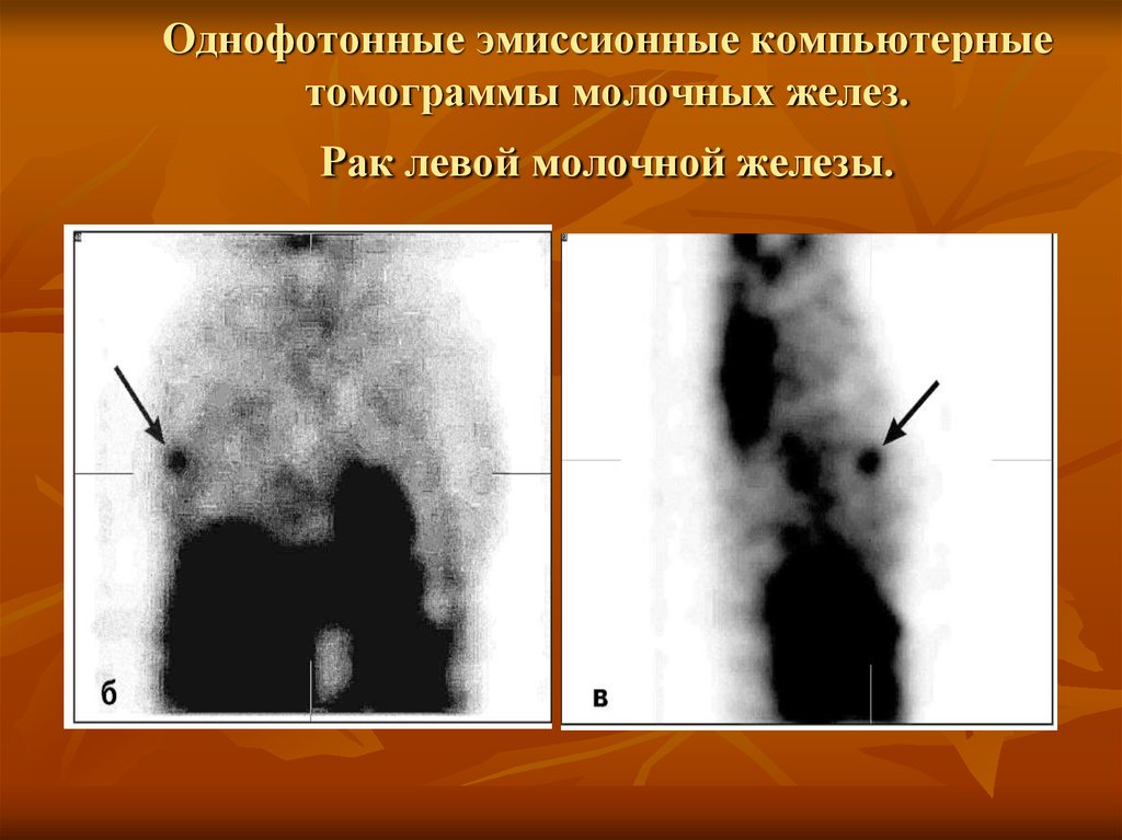 Однофотонные эмиссионные компьютерные томограммы молочных желез. Рак левой молочной железы.