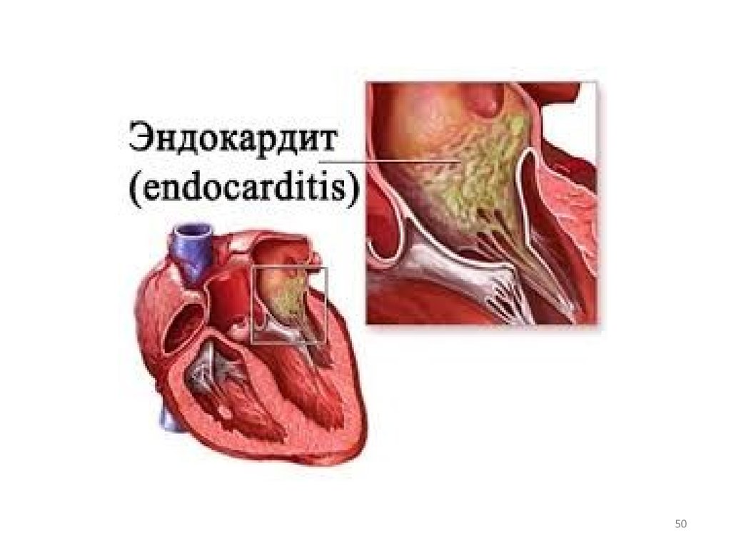 Что такое эндокардит