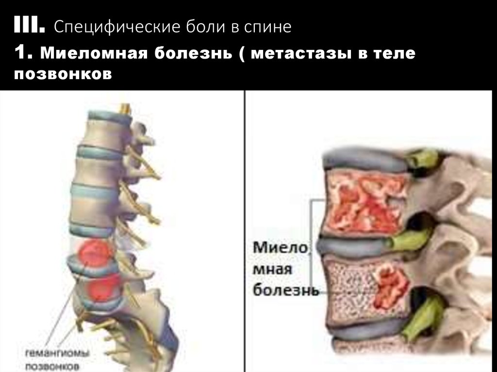 Гемангиома позвоночника рисунок