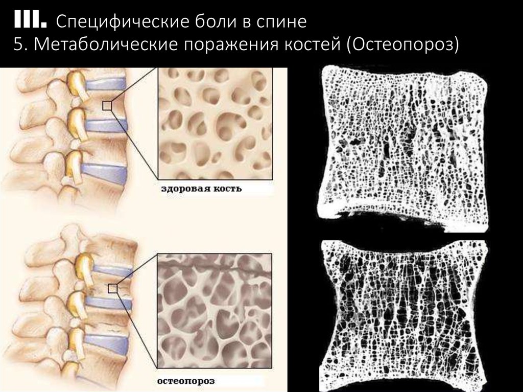 Структурные изменения костей. Остеопороз кость. Остеопороз позвоночника. Остеопороз кость в разрезе.