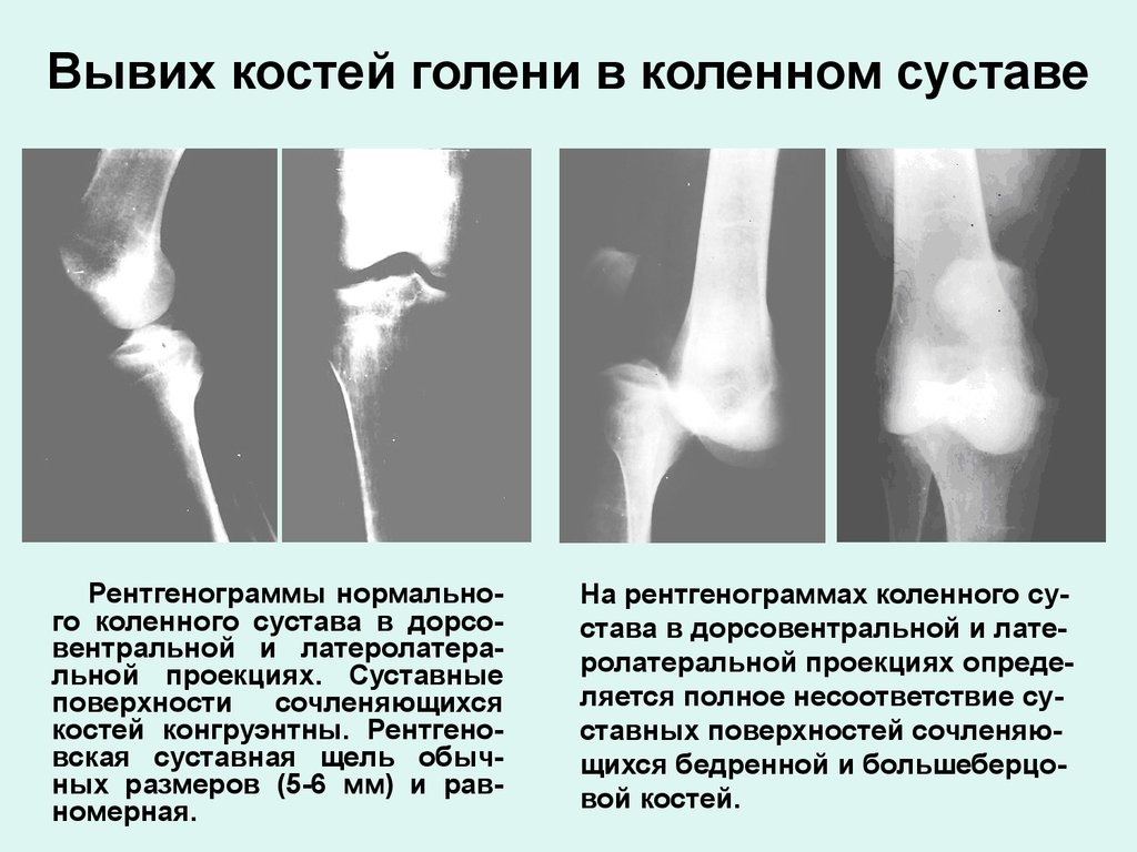 Повреждение костей