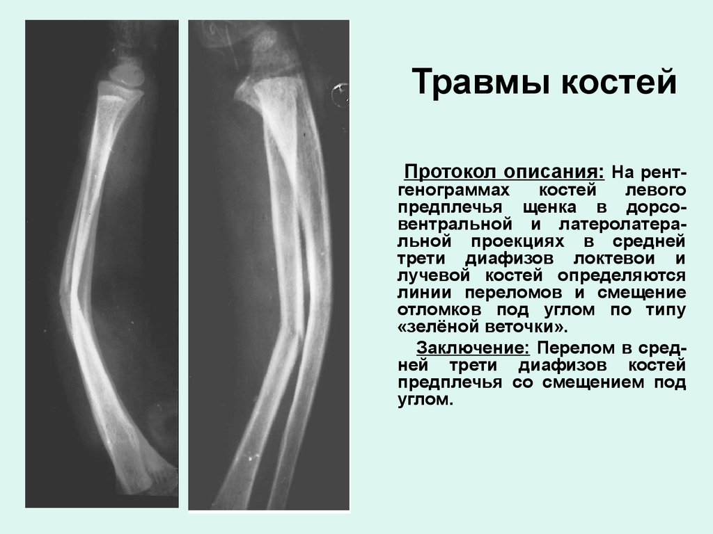 Сколько срастаются лучевые кости